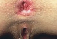 anal gaping hole