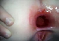 anal gaping hole