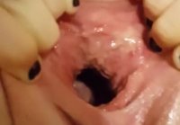 anal gaping hole